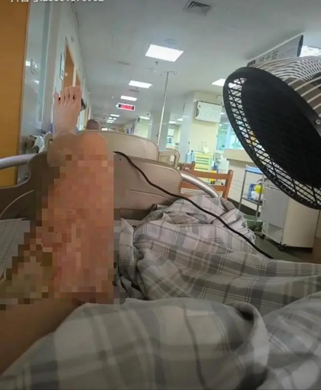 曹雯杰移植大腿皮肤给父亲