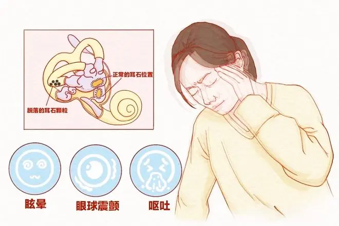 耳石症科普图